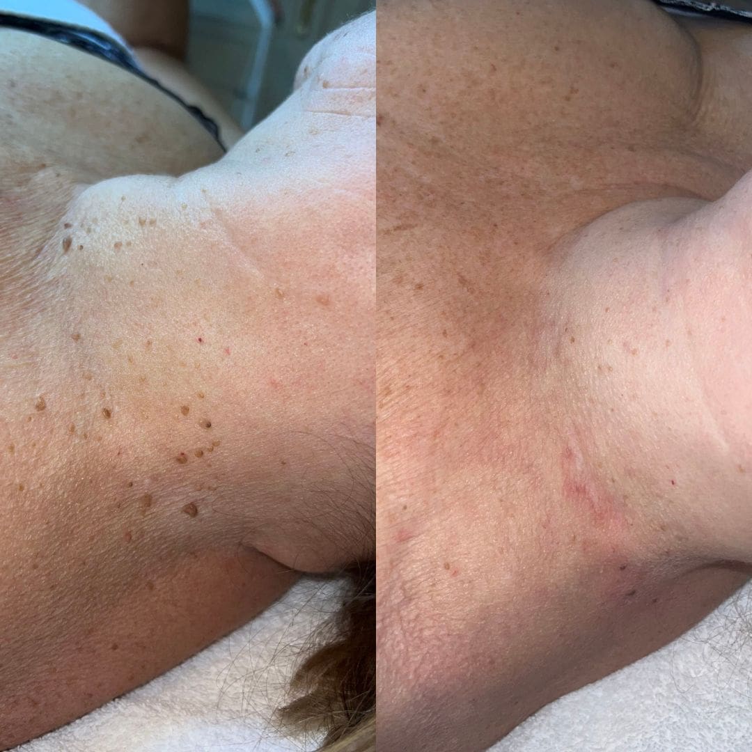 coagulatie fibromen