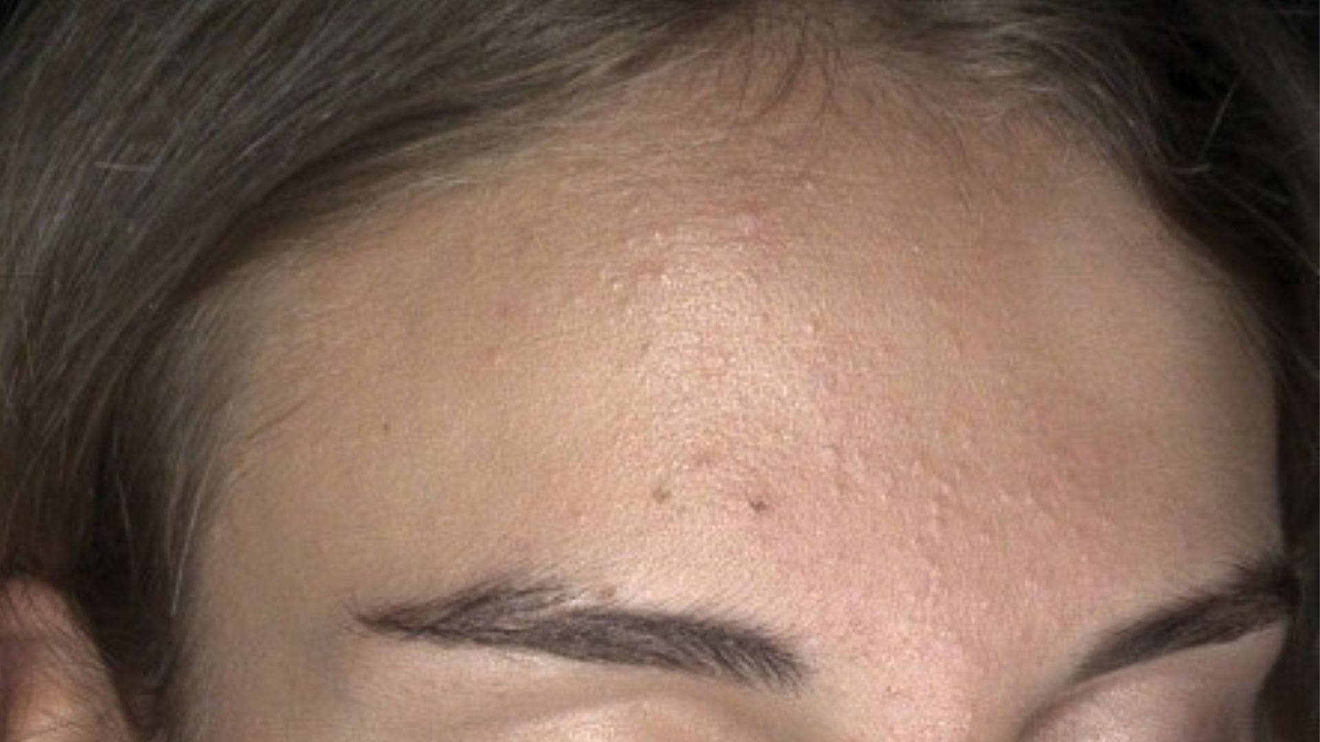 Acne Comedonica