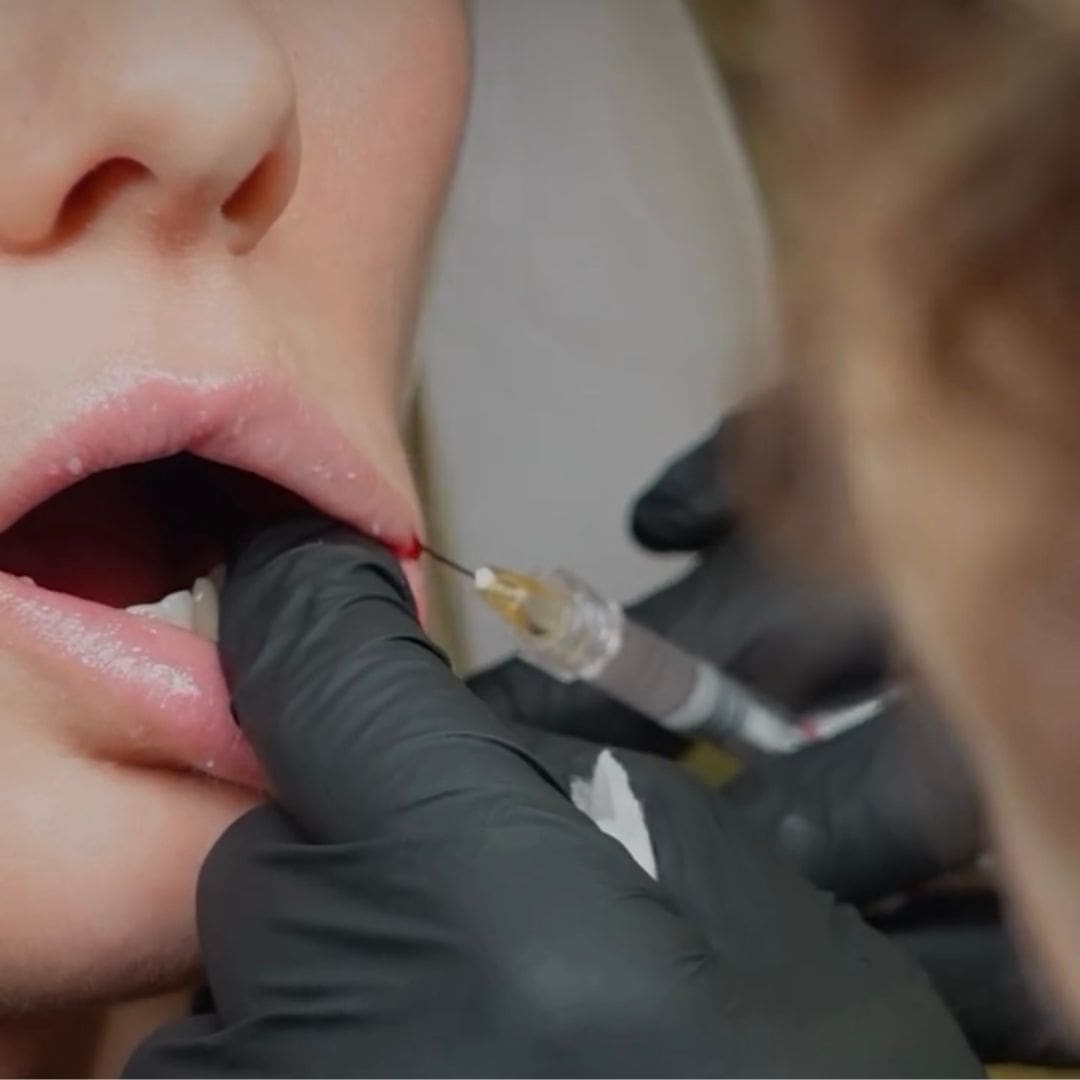 filler_behandeling