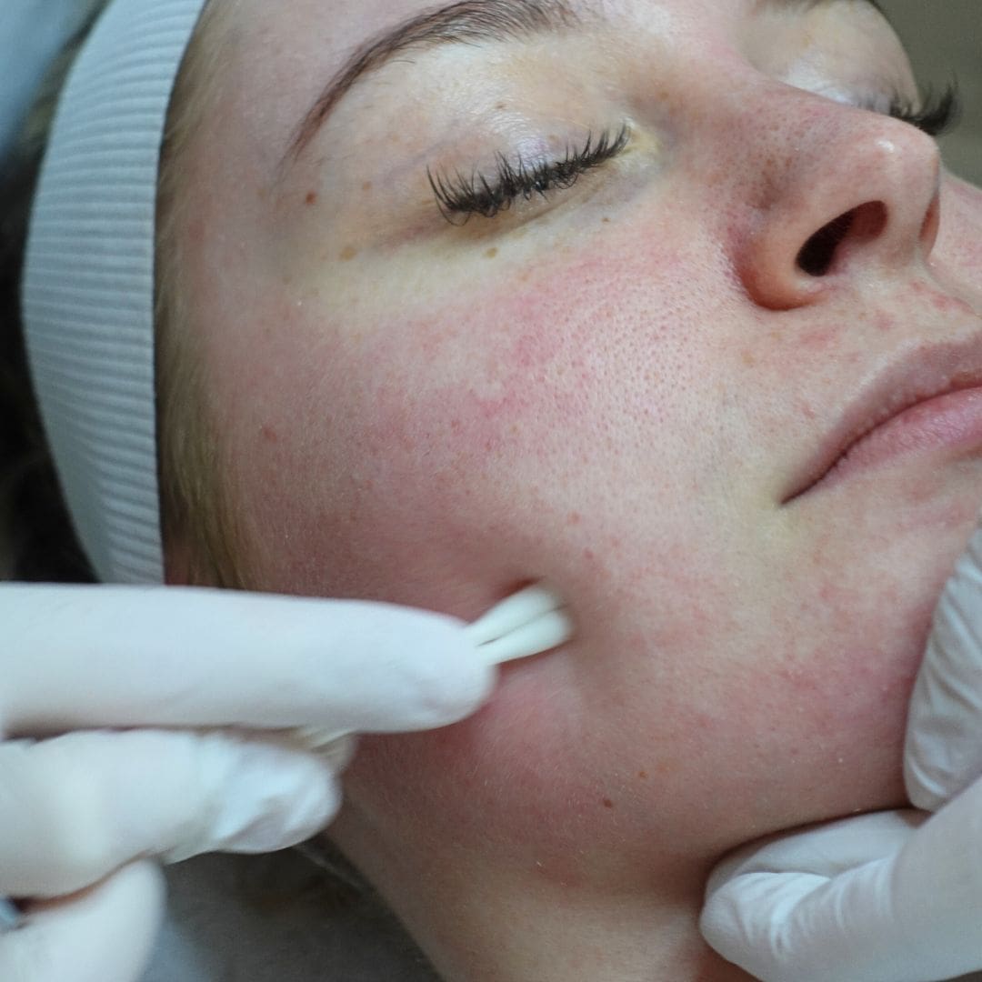 Chemische Peeling