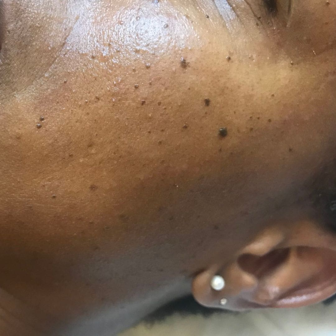 Dermatosis papulosa nigra