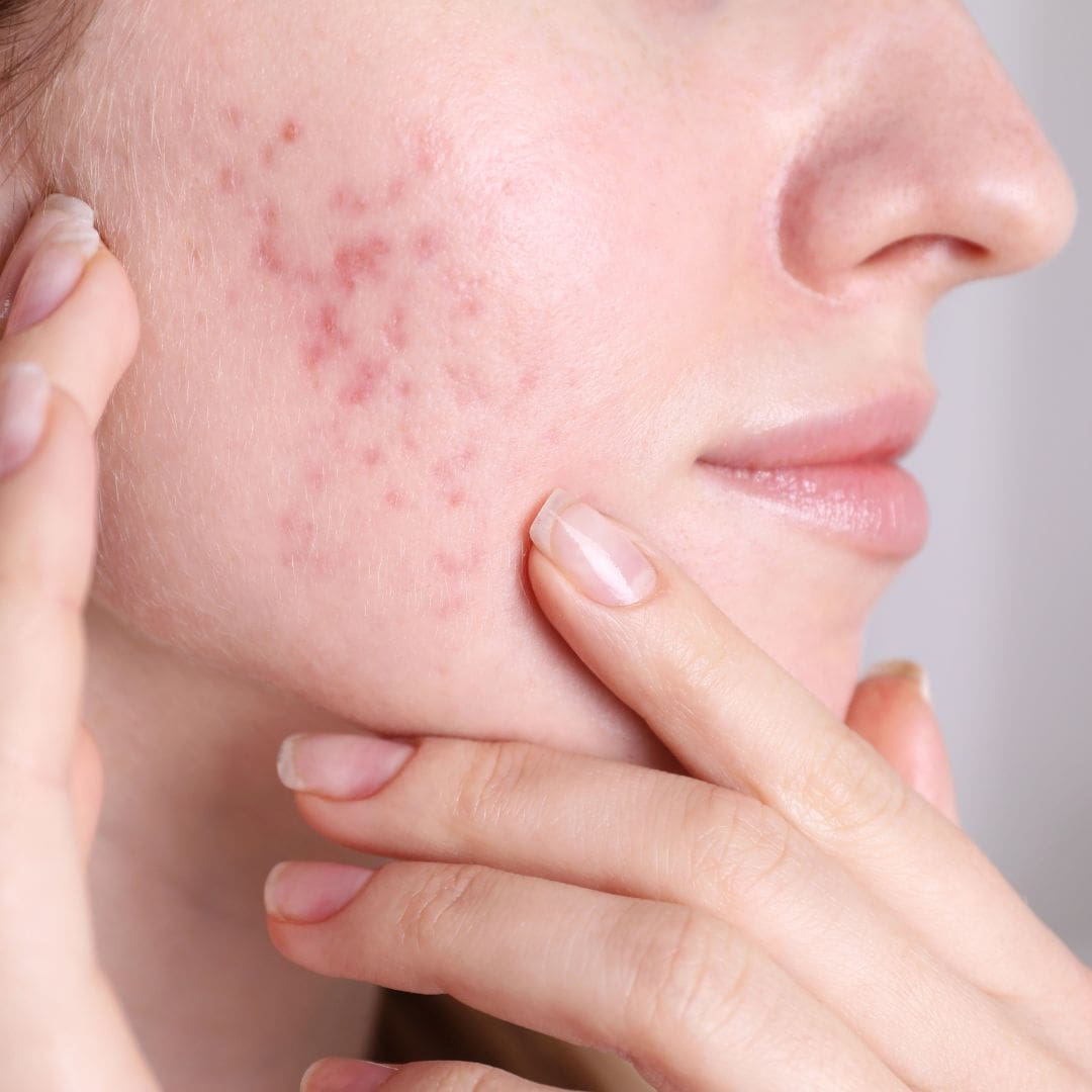 acne littekens