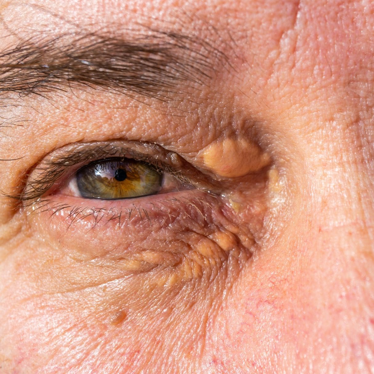 Xanthelasma