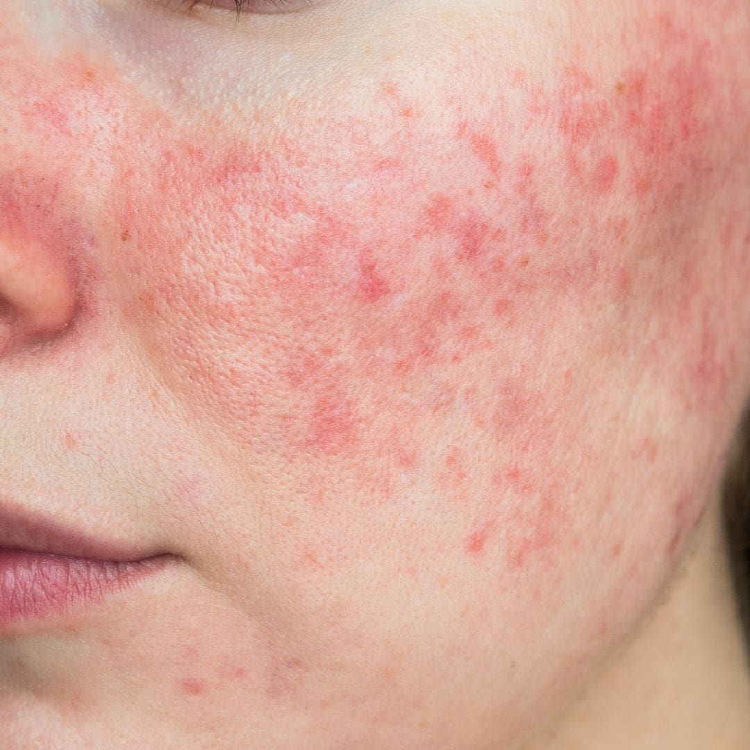 rosacea
