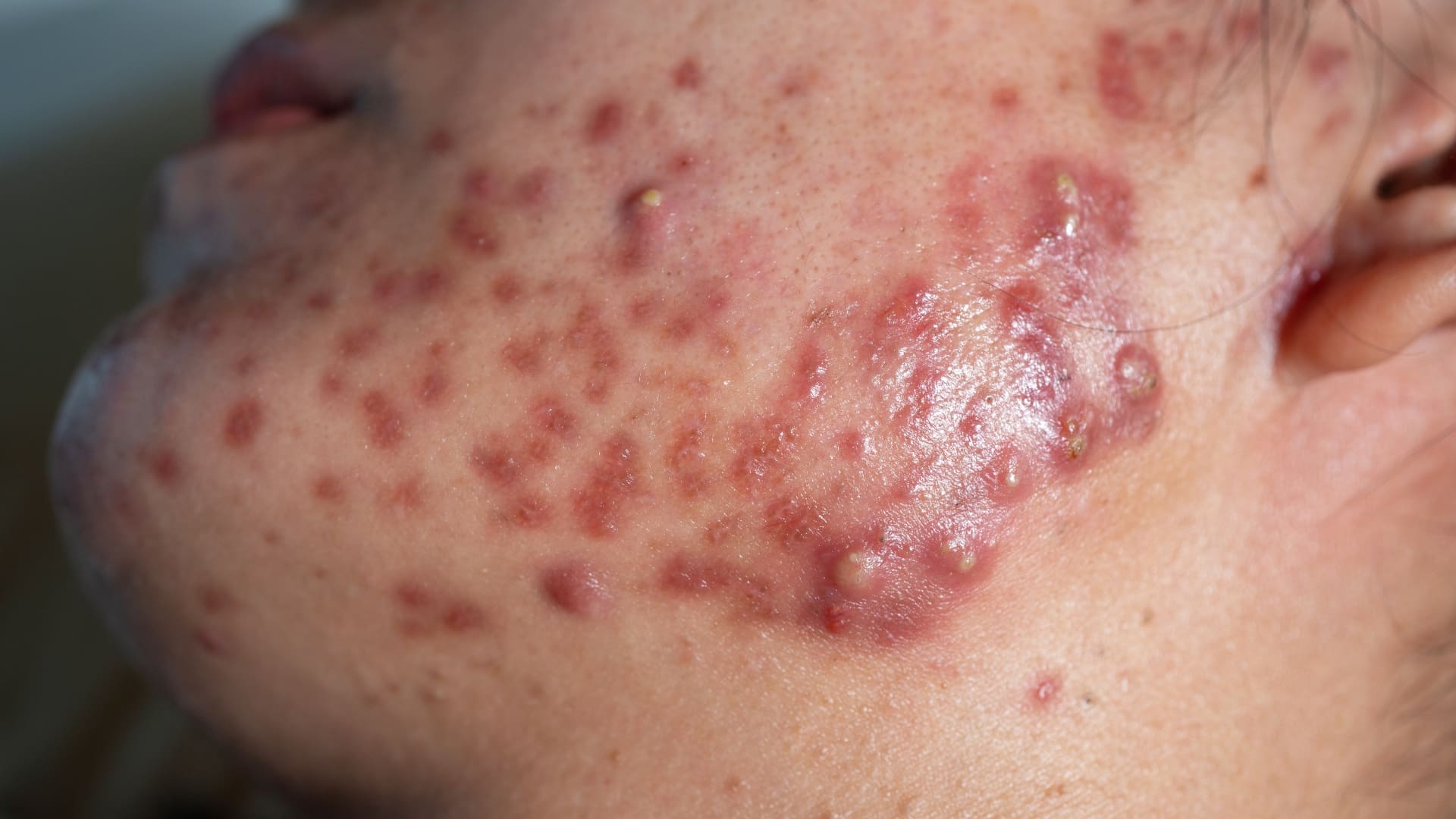 cystische acne