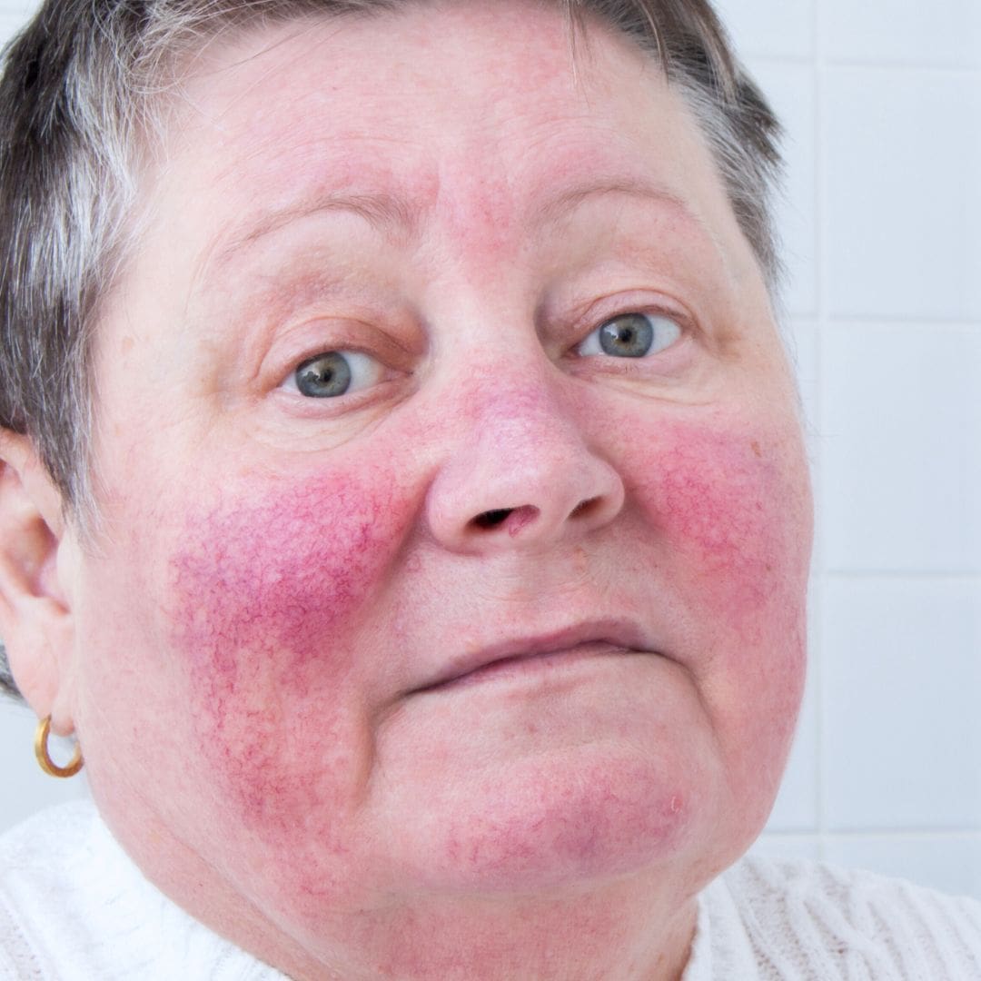 Erythemato-teleangiëctatische rosacea