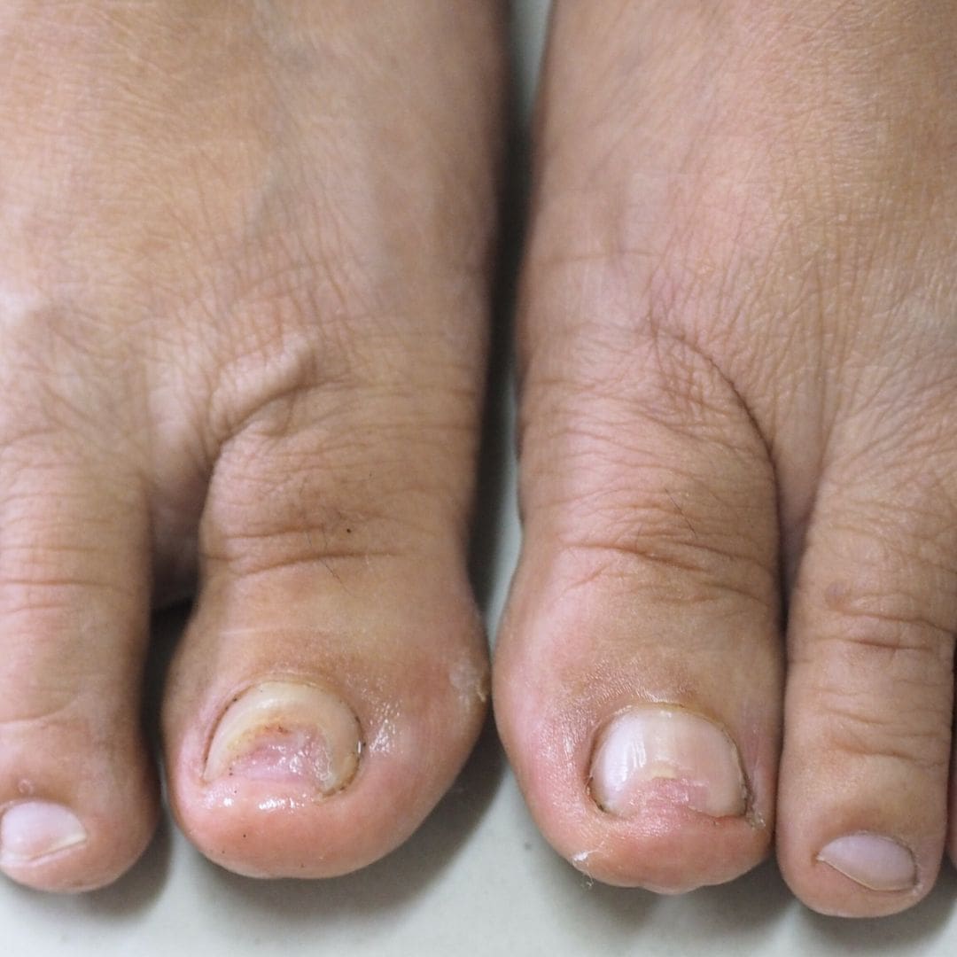 schimmelnagels
